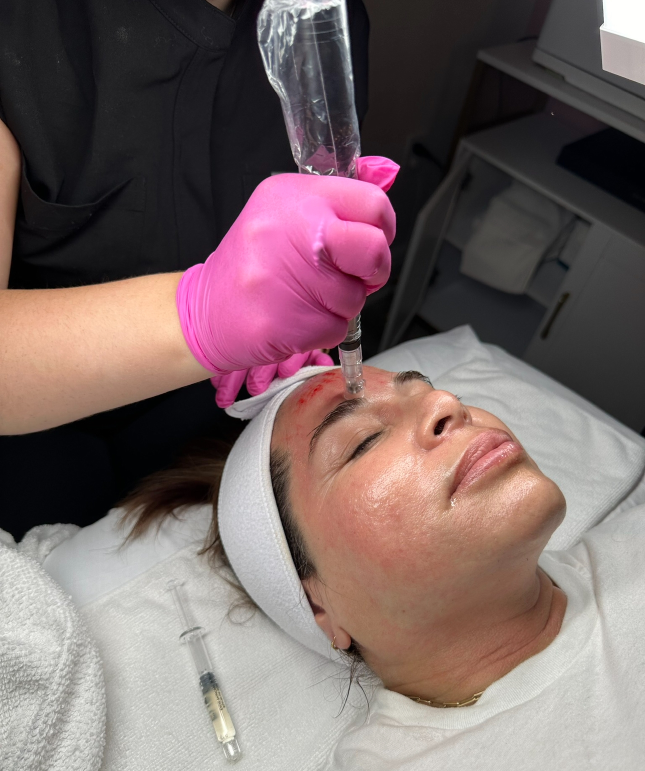 Microneedling process