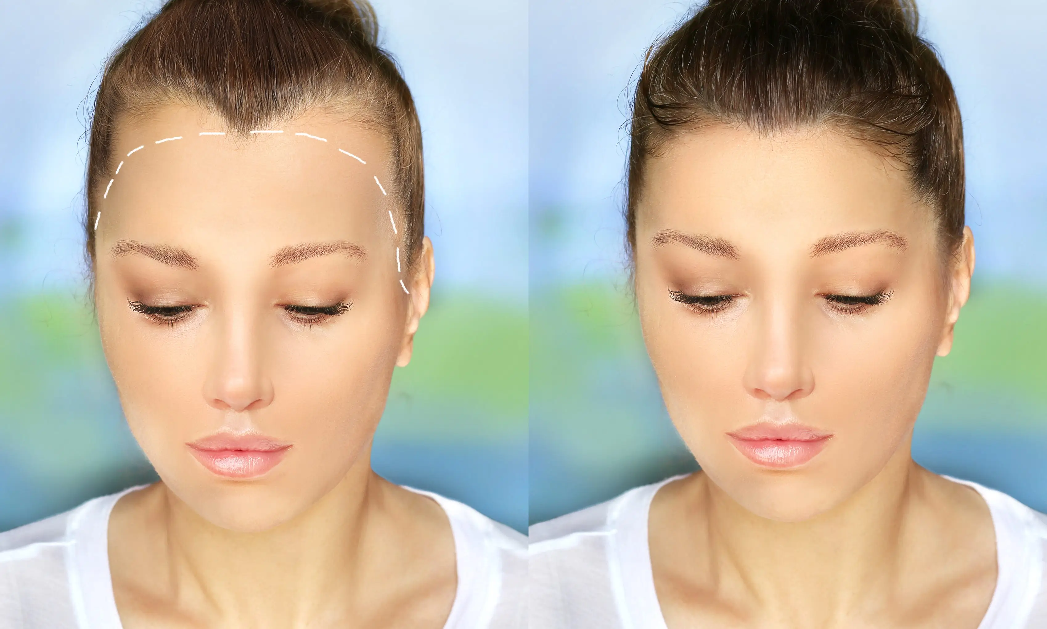 Before and after female hairline restoration