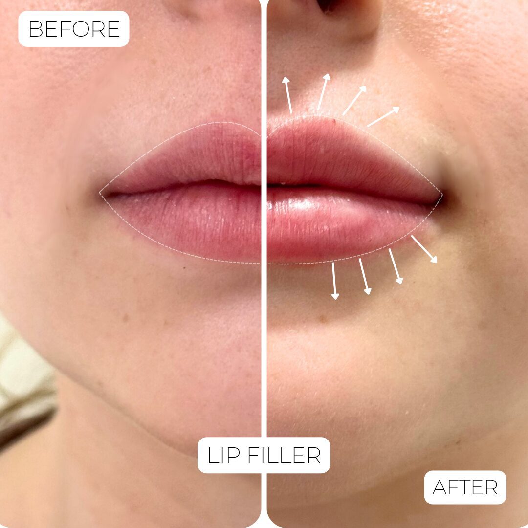 Lip filler treatment at Metairie Med Spa