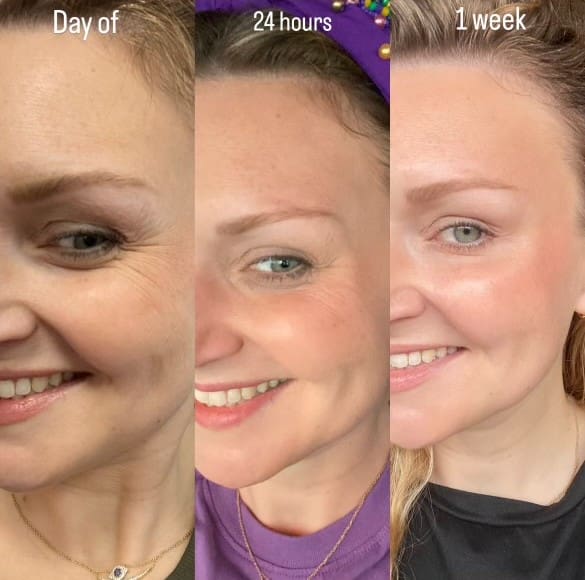 Botox treatment at Metairie Med Spa
